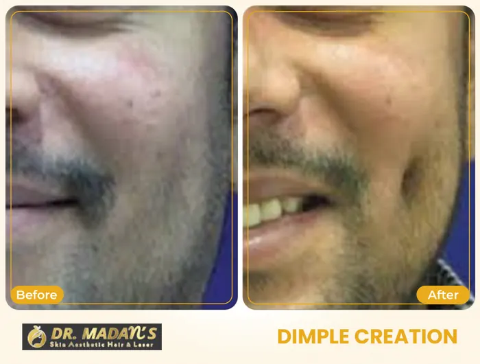 Dimple creation before and after result 2 at Dr Madan Aesthetics